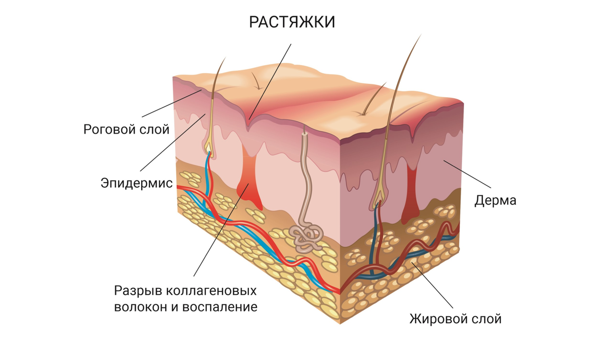 как избавиться от растяжек на груди при беременности фото 90