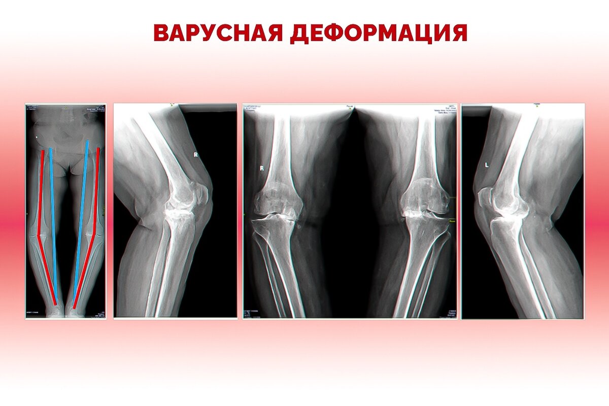 Почему деформируются колени? Отвечает ортопед | Новосибирский НИИТО | Дзен