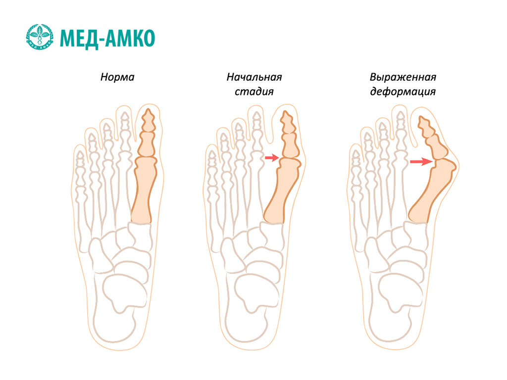 Степени вальгусной деформации 1 пальца. Вальгусная деформация большого пальца стадии. Вальгусное отклонение 1 пальца стопы степени. Степени вальгусной деформации 1 пальца. Вальгусная деформация стопы hallux valgus.