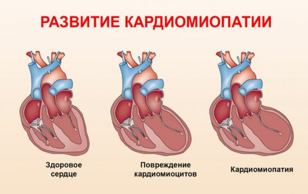 Дилатационная кардиомиопатия что это такое. Кардиопатия сердца симптомы. Кардиопатия дилатационная кардиомиопатия. Заболевания сердца кардиомиопатии.