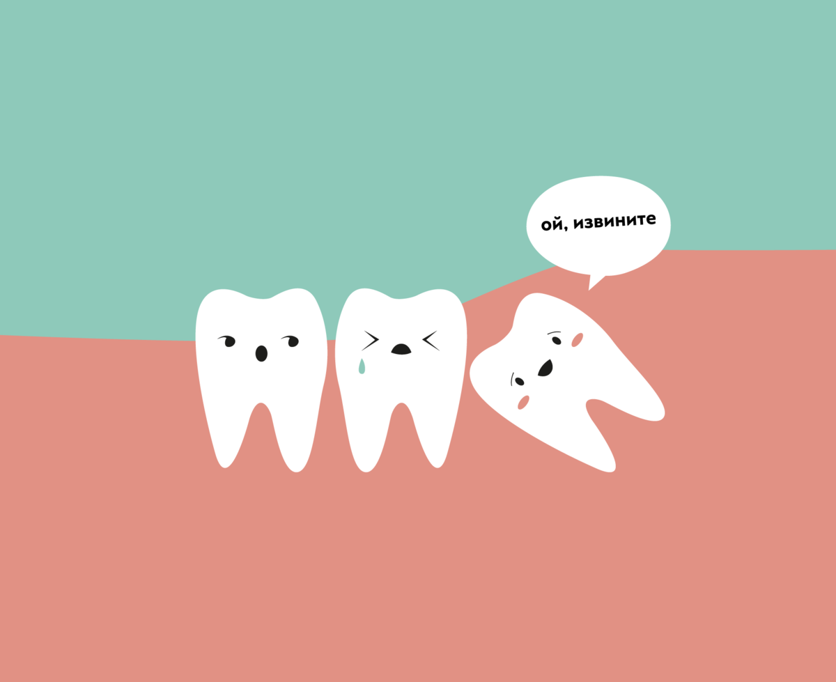 Часто прорезывание зуба мудрости сопровождается сильной болью. А в некоторых случаях без хирургического вмешательства “восьмерка” вовсе не может нормально прорезаться 