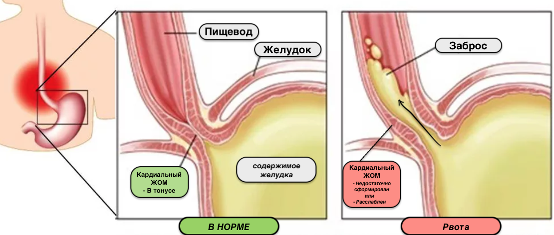 Рвота у детей: причины и первая помощь ребенку