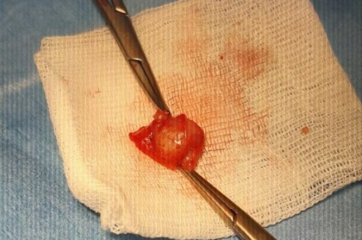    Червя из мошонки удалили пациенту в Нижнем Новгороде