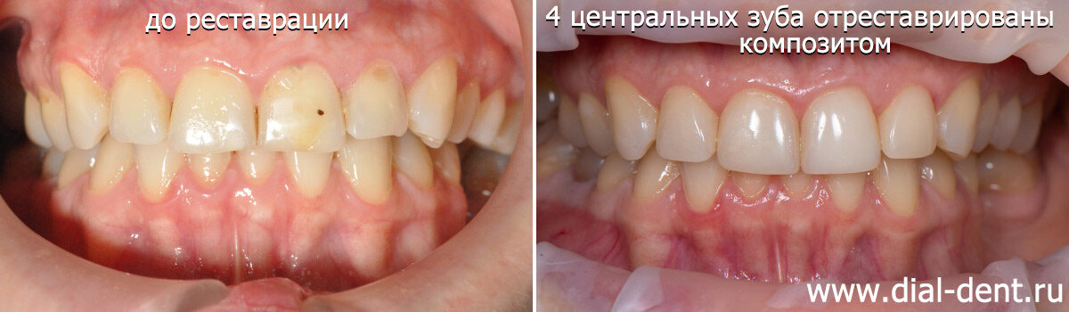 реставрация передних зубов композитом