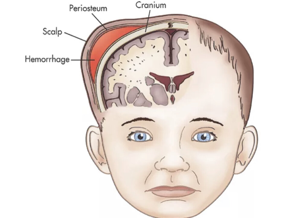 Внутричерепная родовая травма картинки