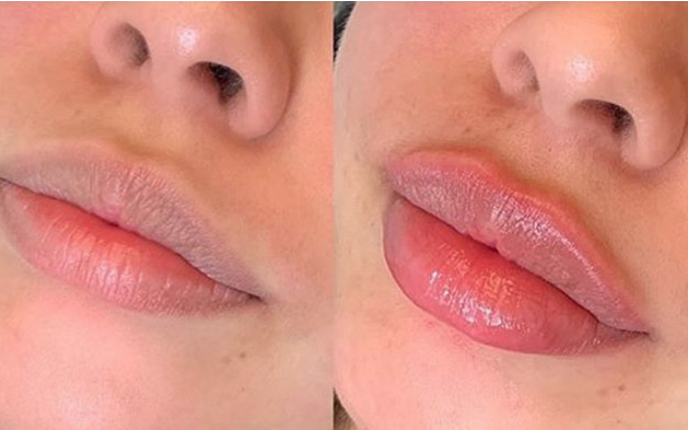 Увеличение губ филлерами
