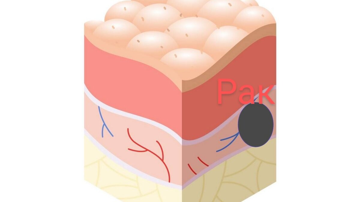 Онкологическое образование может быть в любых слоях органа, тканей, кожи. 