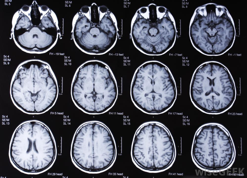 Хтэ болезнь. Магнитно резонансные томограммы головного мозга. Мрт томограмма головного мозга. Снимки мрт головы норма. Опухоль головного мозга т1 т2.