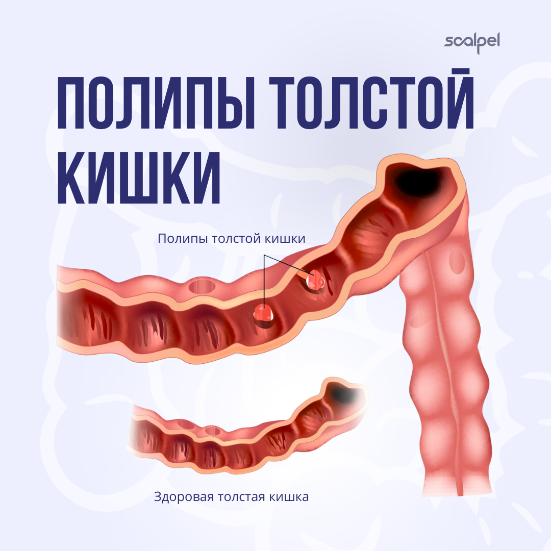 Аденомы желудочно-кишечного тракта (аденоматозные полипы)