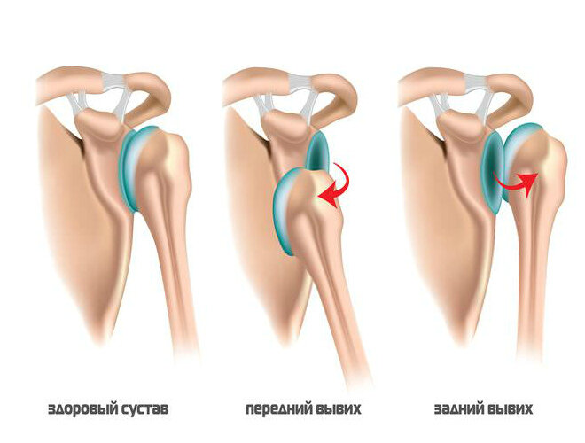 Спортивные травмы плеча