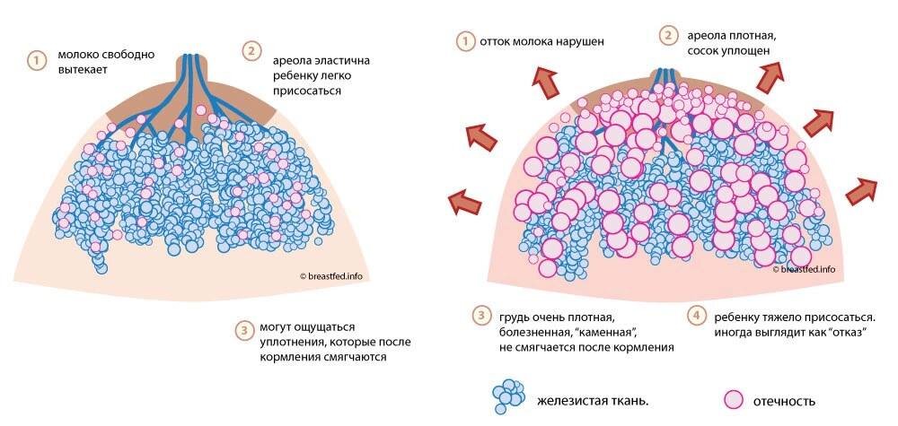 Молочница на сосках: деликатно решаем «больную» тему