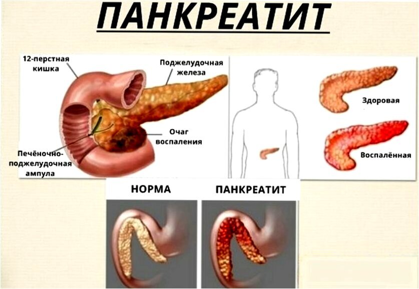 3 очень вредных продукта для поджелудочной железы! Запомните и выведите ...