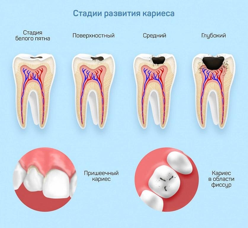 Пришеечный кариес - лечение, фото, причины, стадии