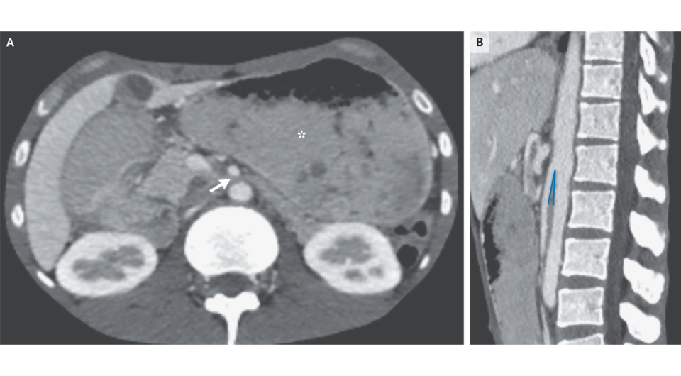   Thibault Kerdiles et al. / The New England Journal of Medicine, 2023
