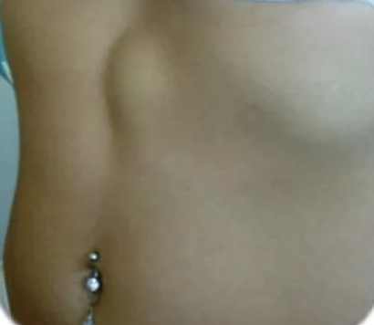 Грыжа белой линии живота в верхней трети