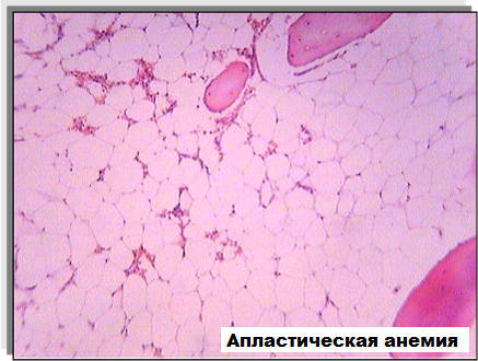 Трепанобиоптат костного мозга. Апластическая анемия