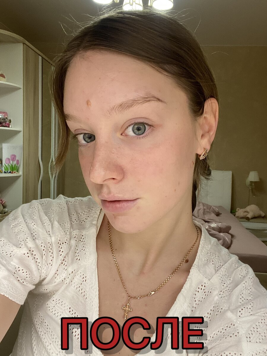 это мое лицо спустя 3 недели использования мазей