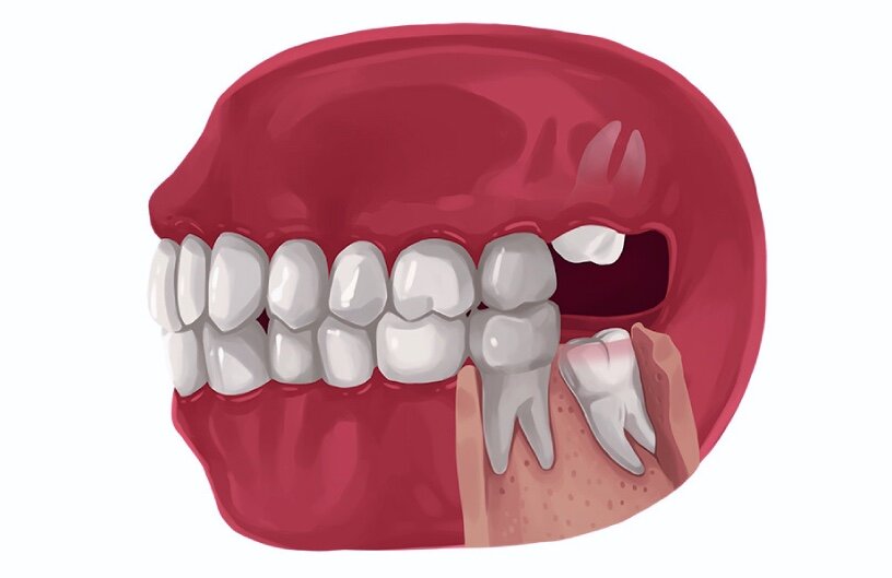 Зачем нужны зубы мудрости? И стоит ли их удалять? Объясняю с научной точки зрения