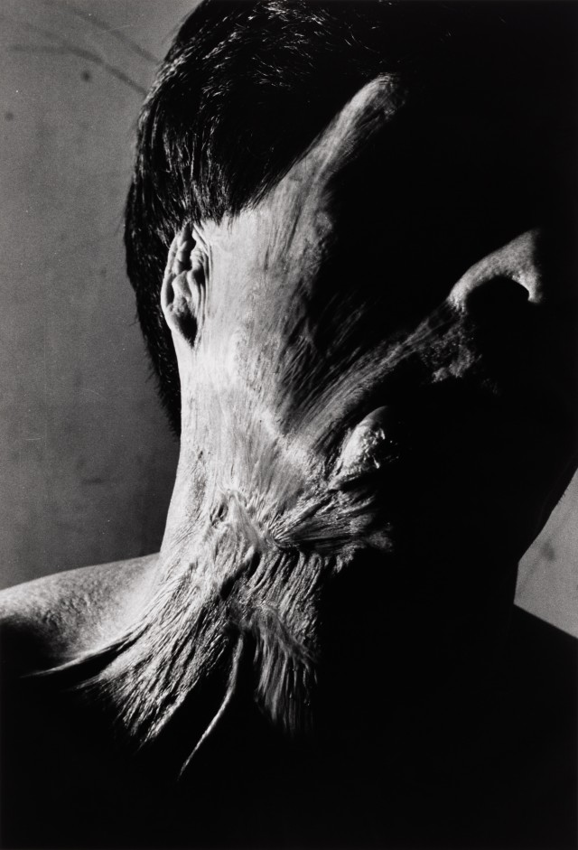 Хибакуша Сенджи Ямагути, Нагасаки, 1962. Фотограф Сёмэй Томацу