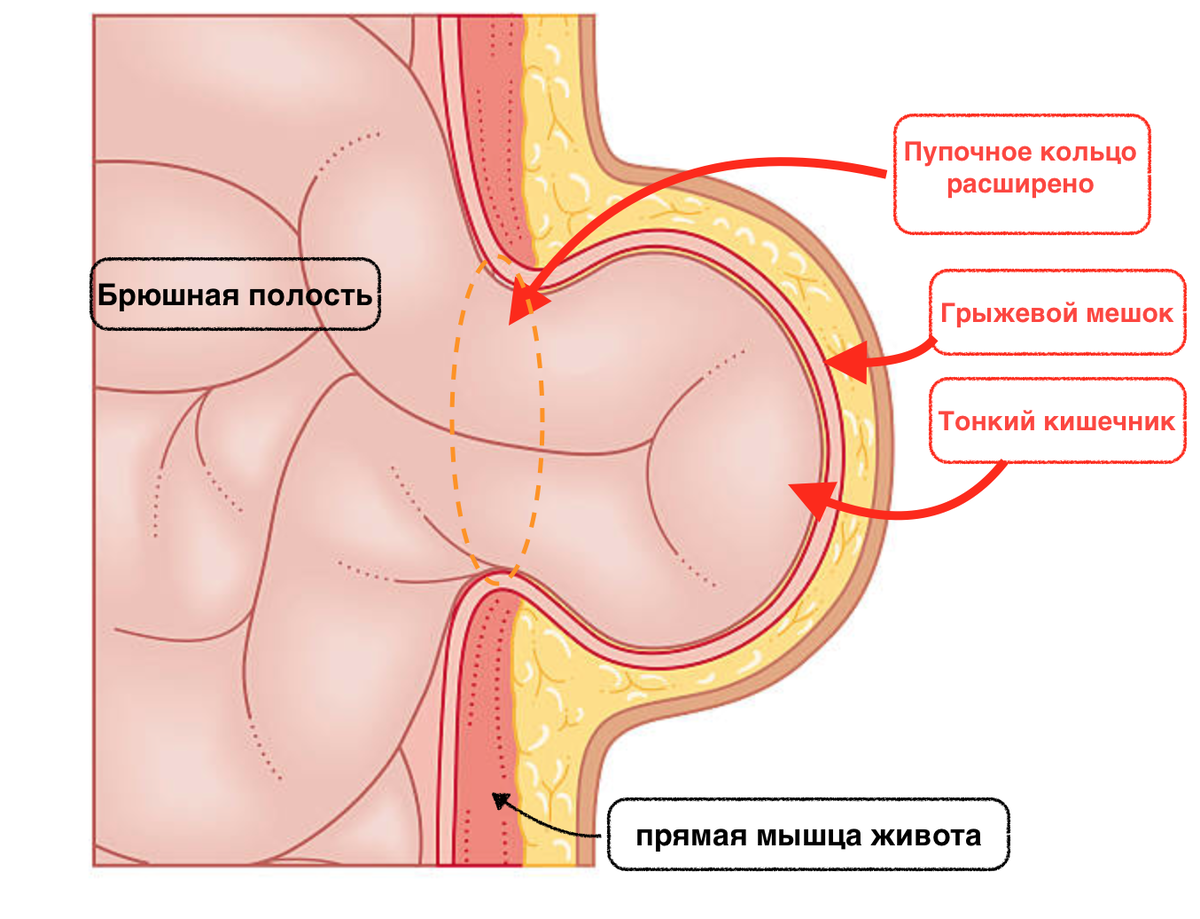 Пупочная грыжа у детей | Со слов Детского Хирурга | Дзен