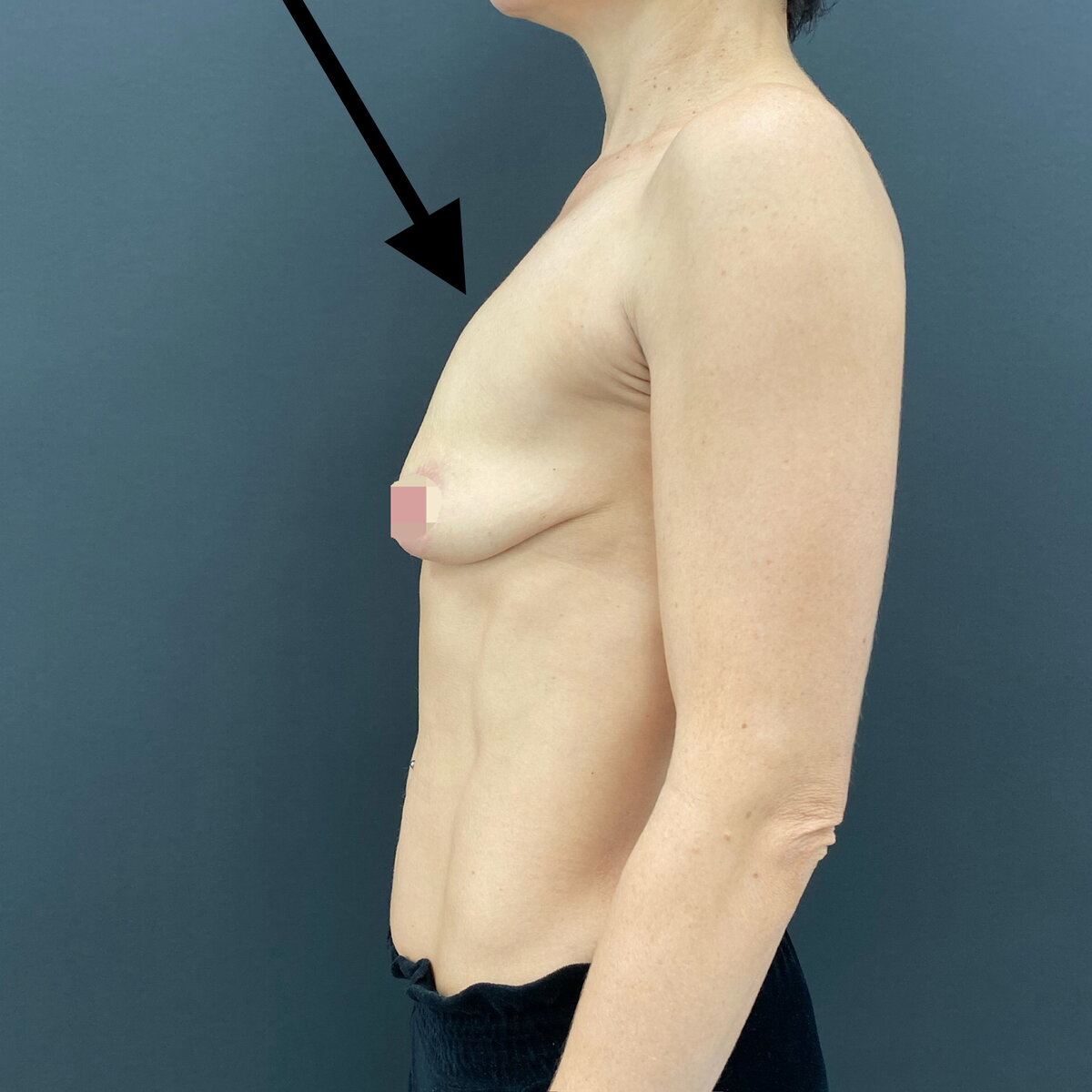 силиконовый имплант груди фото 109