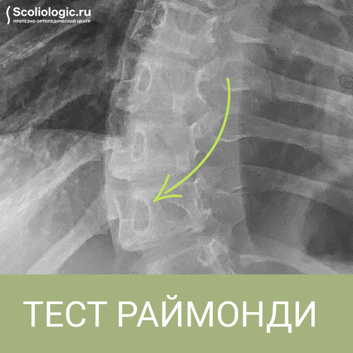 Метод Раймонди. Что это и причем тут сколиоз? | Протезно-ортопедический  центр | Дзен