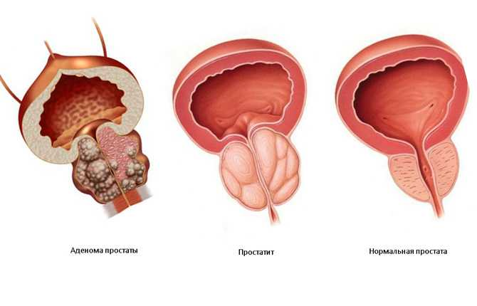 Предстательная железа воспаление. Аденома предстательной железы. Простата у мужчин. Воспаление аденомы простаты.