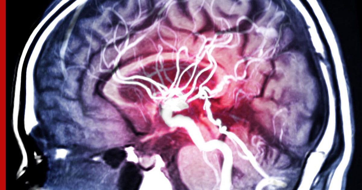 Последствия сужения сосудов головного мозга. Сужение артерий головного мозга. Стеноз артерий головного мозга. Гиперденсивность сосудов головного мозга.