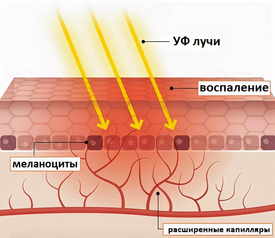 Пигмент меланин в каком слое. Воздействие УФ излучения на кожу. Солнечное излучение и влияние на кожу. Ультрафиолетовое излучение воздействие на кожу. Воздействие УФ лучей на кожу.
