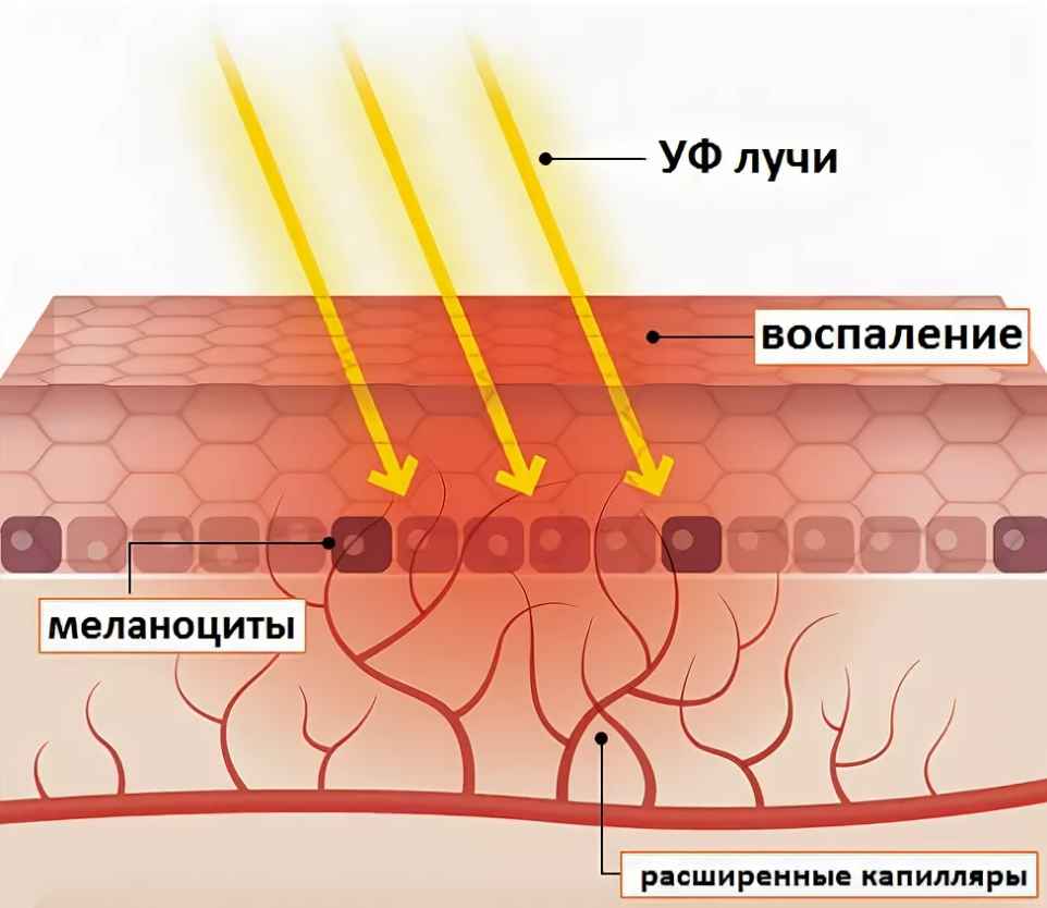 Под действием ультрафиолетовых лучей в коже образуется. Воздействие УФ излучения на кожу. Воздействие ультрафиолета на кожу. Воздействие УФ лучей на кожу. Воздействие солнечного излучения на кожу