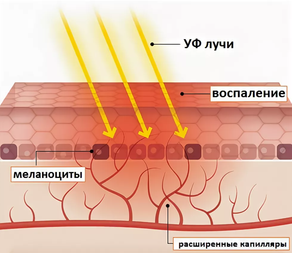 В кожу в результате. Воздействие УФ излучения на кожу. Влияние солнечного излучения на кожу. Воздействие ультрафиолетового излучения на кожу. Воздействие УФ лучей на кожу.