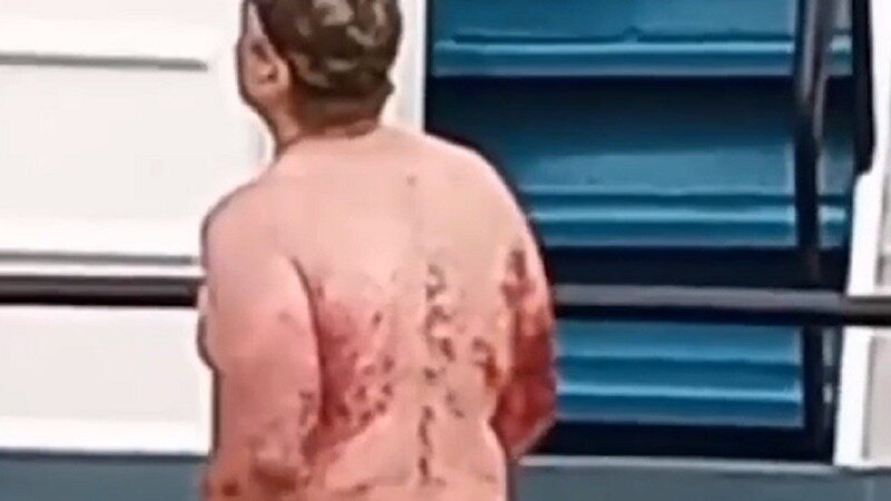     В сети появилось видео с мужчиной, сильно искусанным насекомыми — на его теле огромные кровоподтеки и шишки.