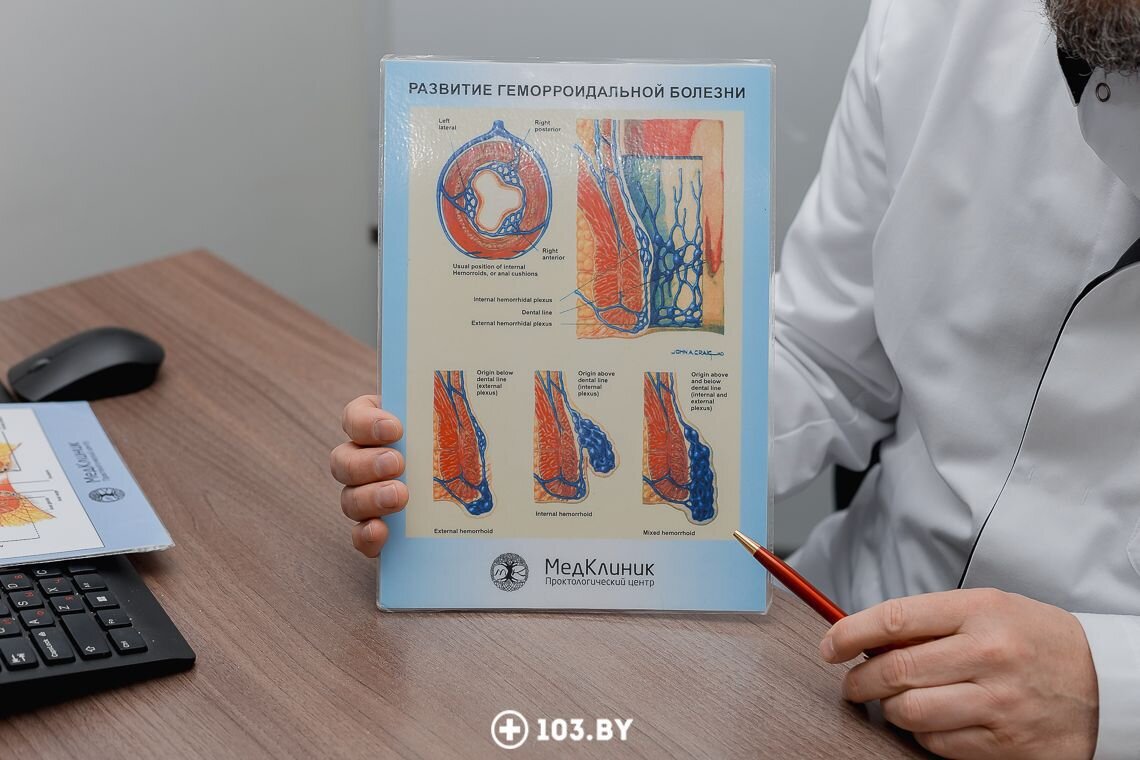 👨‍⚕️ Геморроидальный тромбоз. Почему развивается и как лечить,  рассказывает врач-проктолог | 103.by | Дзен