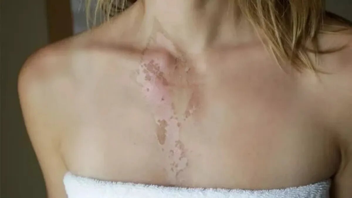 Шелушащийся солнечный ожог может увеличить риск развития рака кожи (Изображение: GETTY)