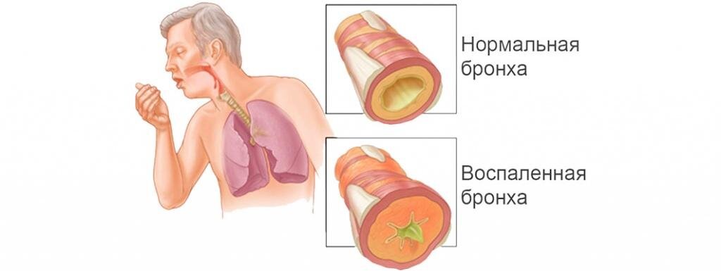 Бронхит - симптомы заболевания, диагностика и способы лечения