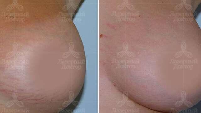 Результат процедуры будет заметен уже после первого сеанса, а по мере прохождения сеансов эффект будет увеличиваться. По окончании курса молодые стрии исчезнут полностью, а старые превратятся в полоски, которые тоньше человеческого волосы, а потому фактически незаметны невооруженным глазом. Обычно требуется до шести процедур, чтобы добиться максимального эффекта.