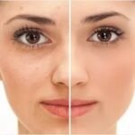 Устраняет морщинки вокруг глаз, даже «гусиные лапки». 		        
        
 