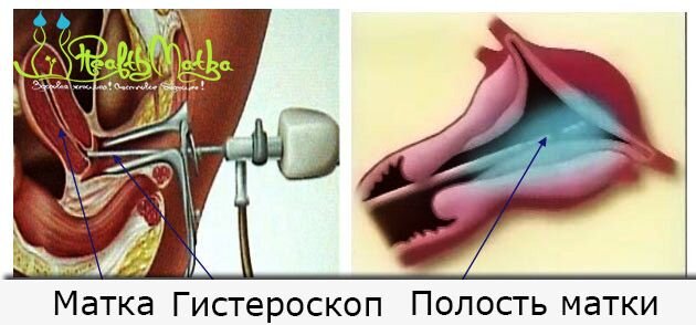 Биопсия шейки матки в Киеве