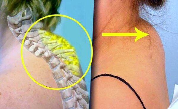 Схематичное изображение вдовьего горба