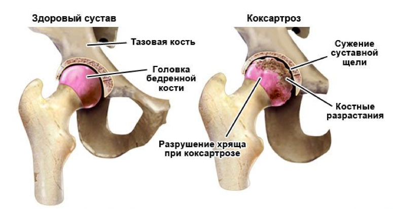 Ядро головки бедренной кости