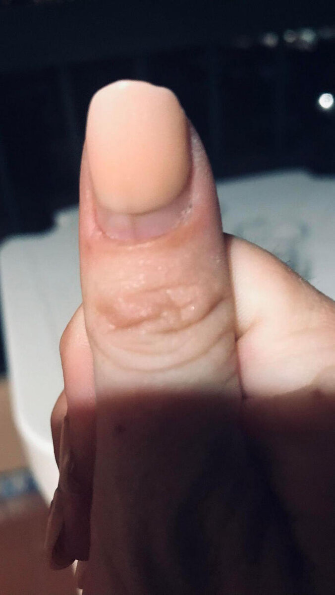    Вот так палец Стейси выглядел до удаления накладного ногтя.Фото: соцсети