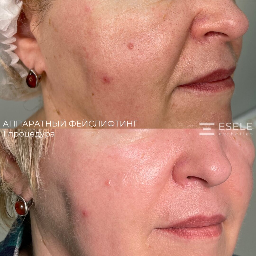 Процедуры фейслифтинга могут помочь вам избавиться от головных болей. Фото © Центра эстетики и косметологии ESELE 