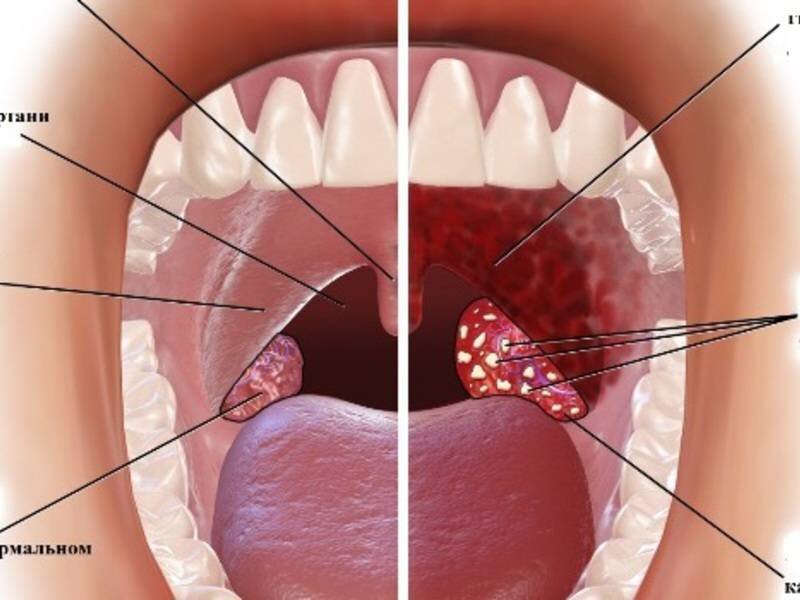Воспаленные гланды в горле фото