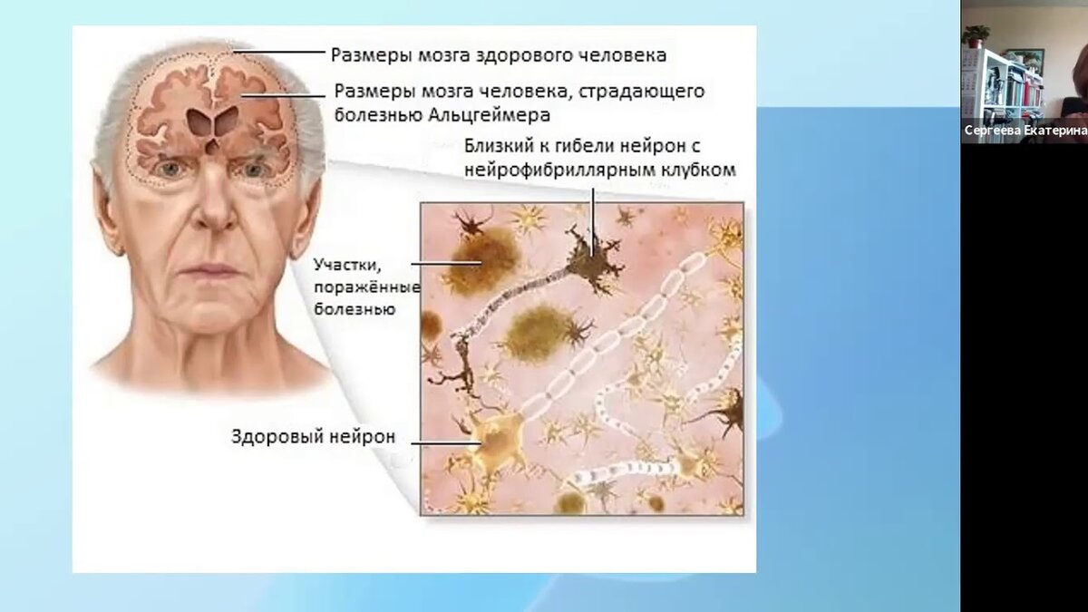 Картинки от болезни альцгеймера
