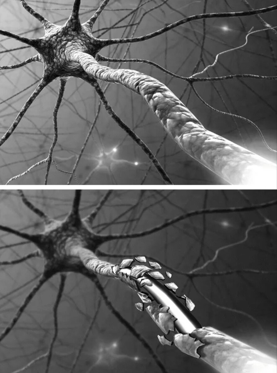 Нервное волокно может повреждаться высоким уровнем глюкозы или креатинина крови, токсическими соединениями тяжёлых металлов или алкоголем. Также нарушение проведения по нерву может быть следствием приема некоторых препаратов.