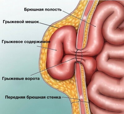 Лечение грыжи белой линии живота