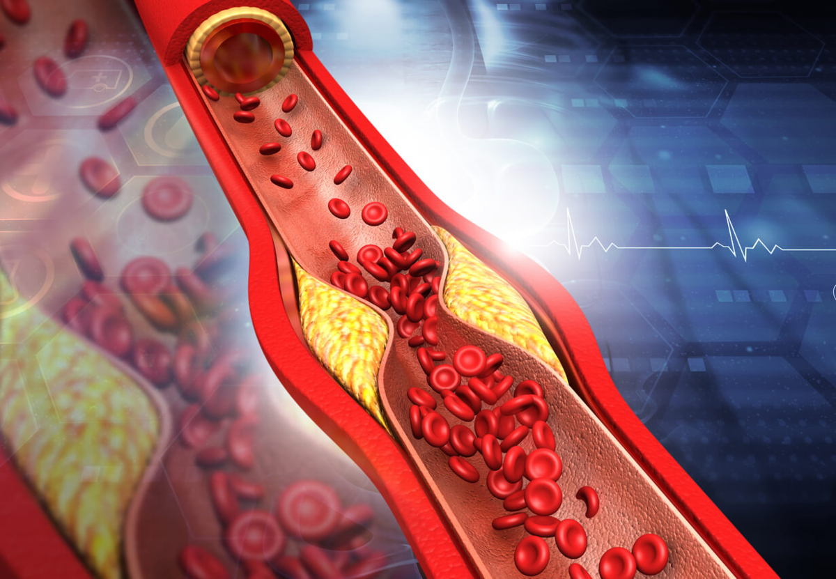 Cholesterol. Холестериновые бляшки на ногах фото. Холестериновые бляшки на коже.