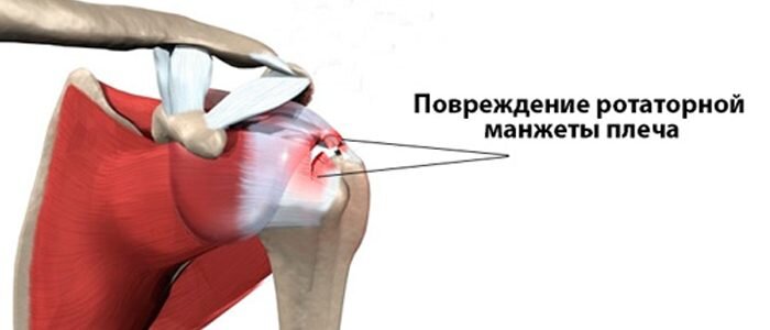 Травмы ротаторной манжетки
