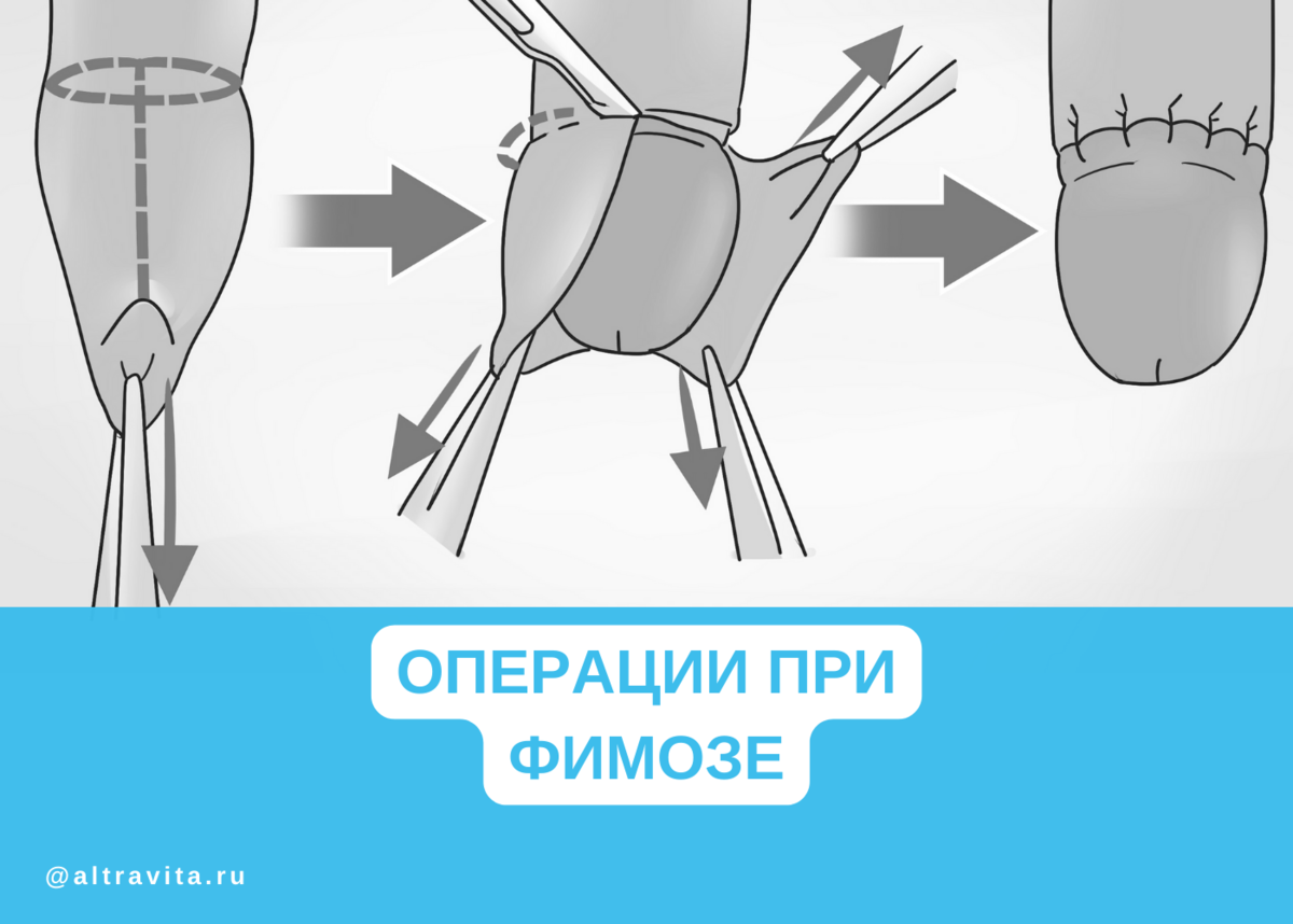 Как выглядит головка после обрезания Модификация метода Смита Блэкфильда Пороки развития мочевого пузыря и уретры