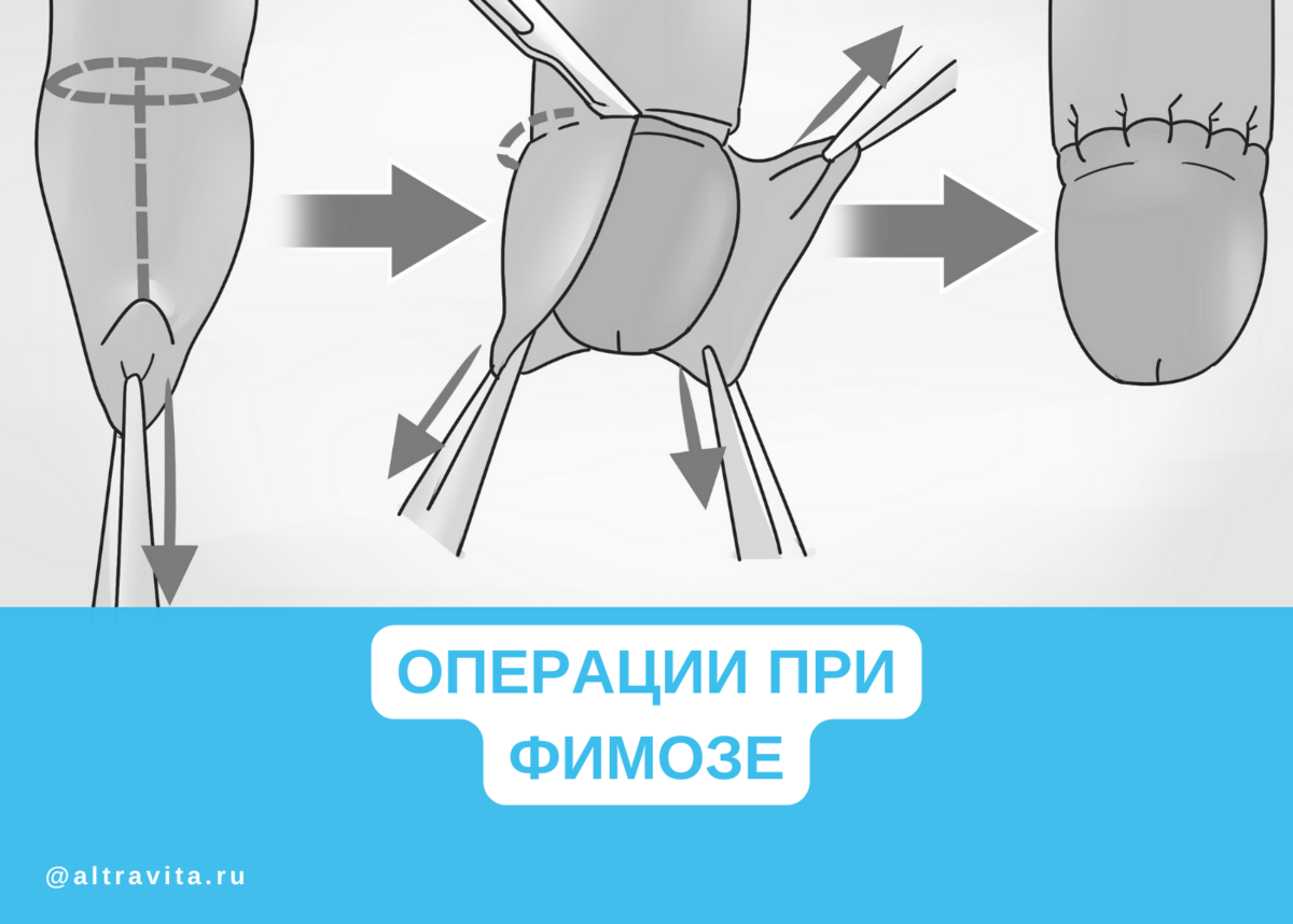 Здоровье маленького мужчины. Фимоз у мальчиков: норма или патология?